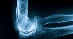 What Bones Are More Vulnerable To Osteoporosis And Why?