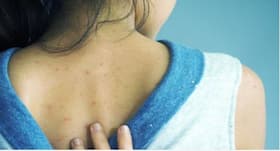 Treat annoying back acne with these 6 effective home remedies