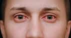 5 effective home remedies to get rid of red eyes