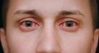 5 effective home remedies to get rid of red eyes