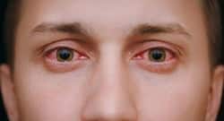 5 effective home remedies to get rid of red eyes