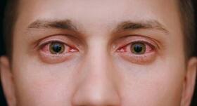 5 effective home remedies to get rid of red eyes