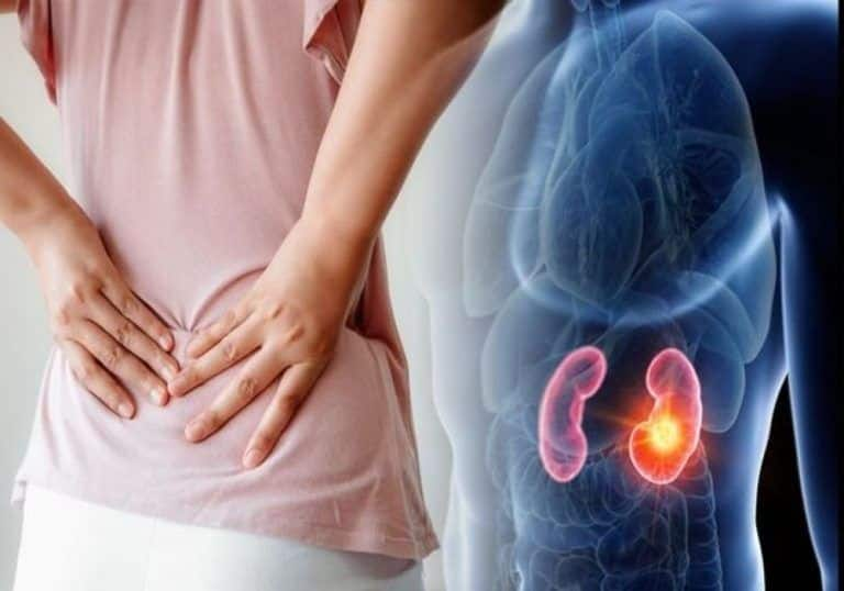 Want to dissolve kidney stones? Try these natural solutions