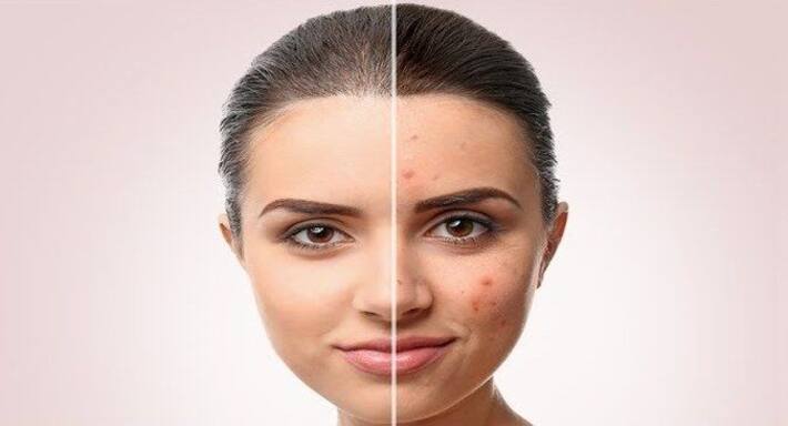 Acne: Types, causes and prevention of this skin infection Acne: Types, causes and prevention of this skin infection
