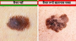 चमड़ी पर मौजूद इन मस्सों में दिखें ये 5 बदलाव तो समझ लें आपको हो गया है स्किन कैंसर, पढ़ें रंग, आकार और होने वाले बदलाव