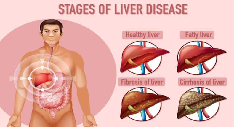 Fatty Liver Diet: फैटी लिवर में फायदेमंद हैं ये 5 फूड, अल्कोहॉलिक और नॉन अल्कोहॉलिक फैटी लिवर रोगी जरूर करें सेवन