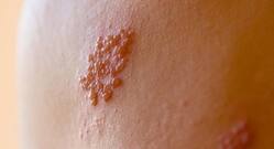 Drug for rare enzyme deficiency may help treat herpes viruses effectively