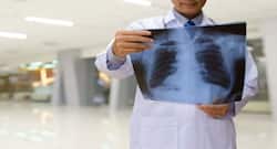 Post-Covid Lung Fibrosis: Prompt Diagnosis And Treatment Key To Manage The Chronic Disease
