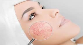 Rosacea: 6 home remedies to get rid of skin inflammation