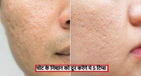 चोट, सर्जरी और मुंहासों के जिद्दी दाग को हटाने के लिए फॉलो करे ये मेडिकेटेड 5 टिप्स, चंद दिनों में बेदाग होगी स्किन चोट, सर्जरी और मुंहासों के जिद्दी दाग को हटाने के लिए फॉलो करे ये मेडिकेटेड 5 टिप्स, चंद दिनों में बेदाग होगी स्किन
