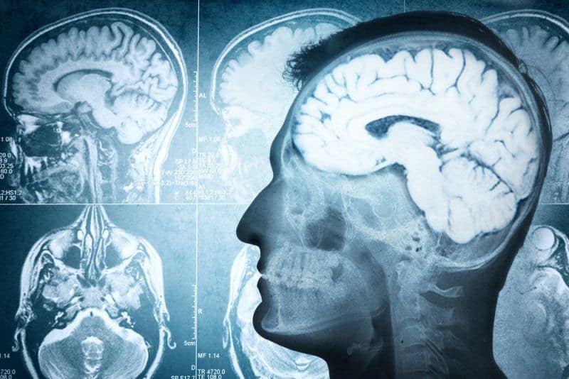 Brain cancer could be triggered by the healing process that follows a stroke or other brain injury: Study