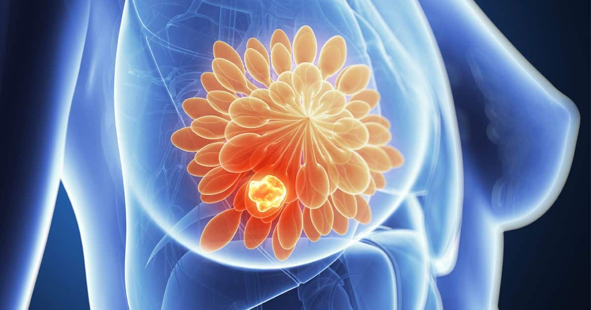 Male Sex Hormones May Help Treat Breast Cancer Heres How