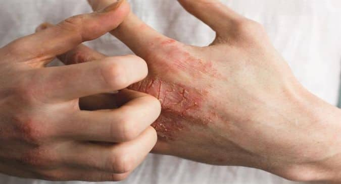 Types of Eczema: 7 तरह का होता है एक्जिमा, जानिए सभी के बीच का अंतर और इनके बचाव के तरीके