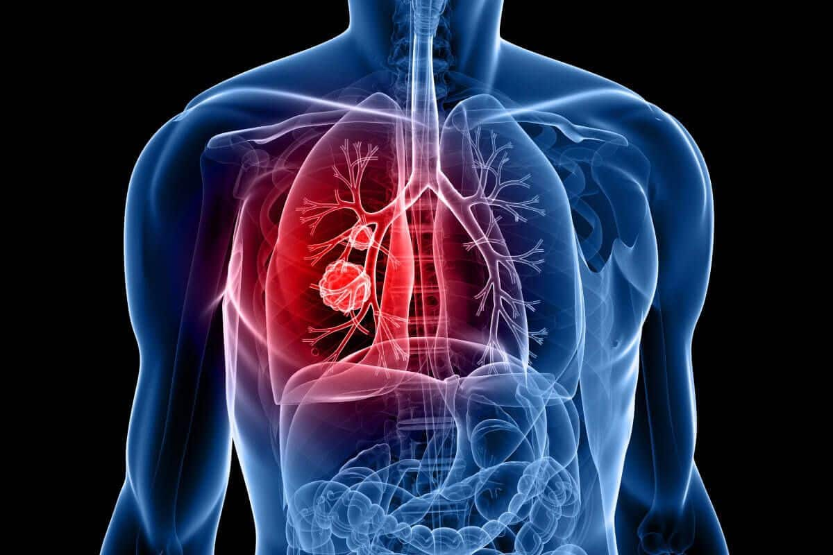 Lung cancer: Warning signs and symptoms you should never ignore