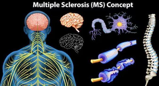 multiple sclerosis, multiple sclerosis development, multiple sclerosis treatment, multiple sclerosis risk factors, multiple sclerosis causes