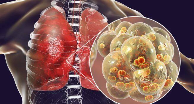 DNA testing can identify pneumonia in severe Covid-19 patients