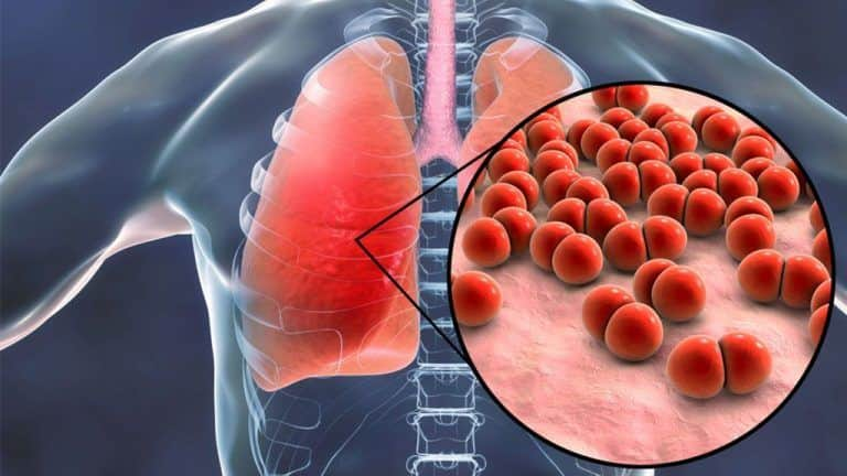 Pneumonia: What you can do prevent this respiratory infection