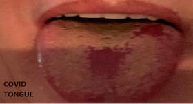 Covid tongues: Many patients suffering from strange coronavirus symptoms not yet listed by WHO