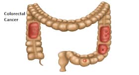Scientists find a way to stop the spread of colorectal cancer tumours