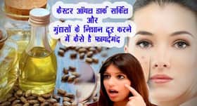 मुंहासों के दाग और डार्क सर्किल की समस्या को दूर करे कैस्टर ऑयल