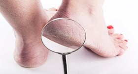 Have dry, cracked heels? 5 effective home remedies to get rid of calluses