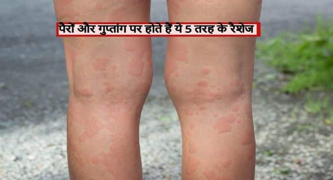 Rashes Bumps And Lumps ग प त ग पर ह न व ल य 5 तरह क र श ज करत ह पर श न Thehealthsite Com ह द