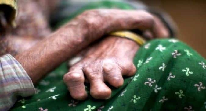 World Leprosy Day 2020: A few facts about this much-misunderstood disease and tips for patients