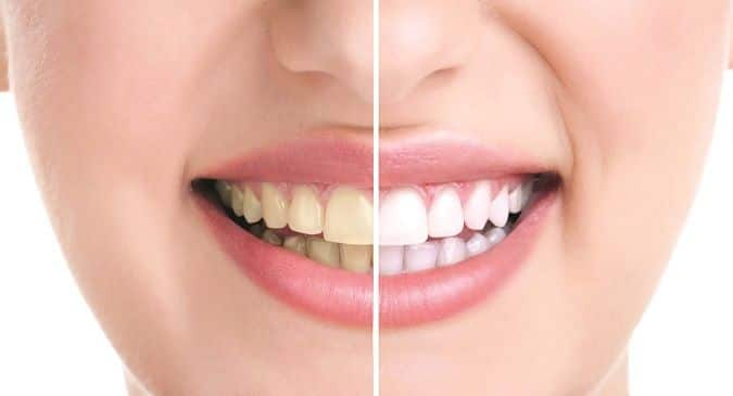 Got yellow teeth? 5 effective home remedies to whiten and brighten them ...