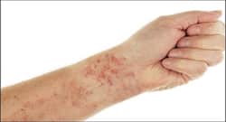 36 COVID-19 vaccine recipients develop rare blood disorder after getting Moderna, Pfizer shots