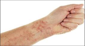 36 COVID-19 vaccine recipients develop rare blood disorder after getting Moderna, Pfizer shots