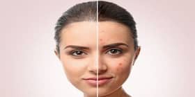Congested skin can cause acne flareups: A few tips to avoid this Congested skin can cause acne flareups: A few tips to avoid this