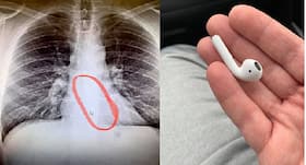 US man accidentally swallows AirPod while in sleep: What to do when things get stuck in your throat? US man accidentally swallows AirPod while in sleep: What to do when things get stuck in your throat?