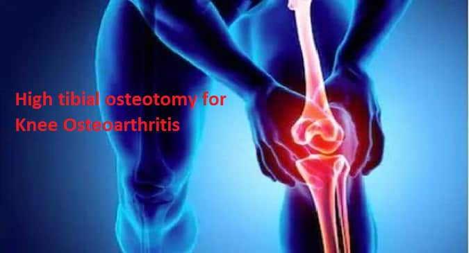 Knee osteoarthritis