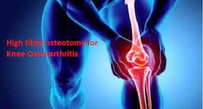 Knee Osteoarthritis: This surgery may prevent the need for total knee replacement