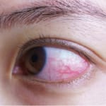 Severe COVID-19 patients may suffer eye abnormalities that might go unnoticed in hospitals