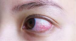 Severe COVID-19 patients may suffer eye abnormalities that might go unnoticed in hospitals