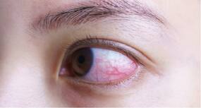 Severe COVID-19 patients may suffer eye abnormalities that might go unnoticed in hospitals