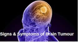 Treatment of brain tumour: Researchers perform 3D biopsies of glioblastoma