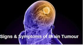 Treatment of brain tumour: Researchers perform 3D biopsies of glioblastoma