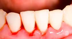 Bleeding gums may be a sign of vitamin C deficiency: What should you do?