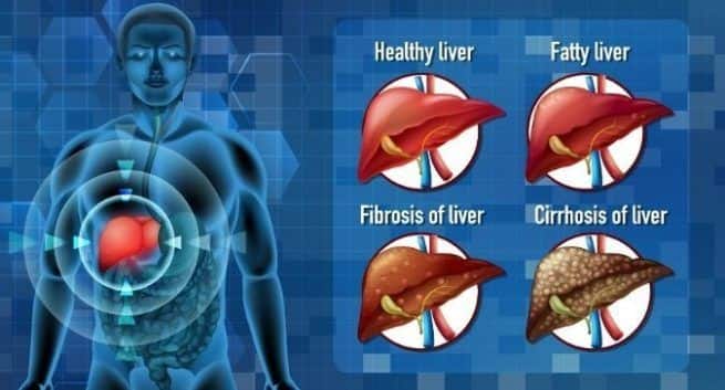 Liver Swelling