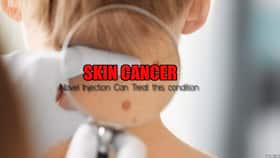 Skin cancer: Forget surgeries, one single injection can easily treat this condition
