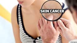 New gene-based blood tests can detect skin cancers and reduce death risks