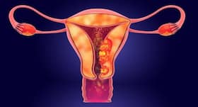 Robotic-Assisted Surgery Breaks New Ground In Uterine Cancer And Infertility