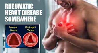Rheumatic heart disease