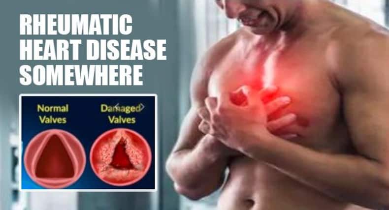 rheumatic-heart-disease