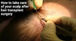 Considering hair transplant surgery? Beware of the possible complications