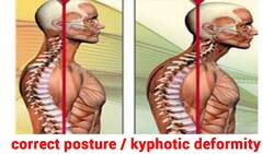 Osteoporosis and kyphotic deformity: A very real risk for post-menopausal women