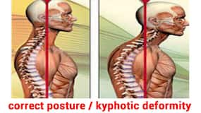 Osteoporosis and kyphotic deformity: A very real risk for post-menopausal women