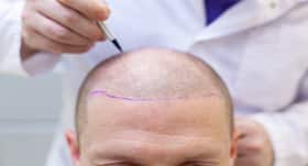 FUT Vs FUE hair transplant: Which one should you choose?
